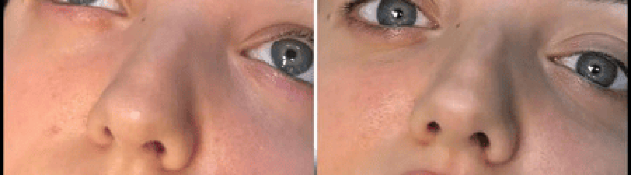 Dermal Fillers
